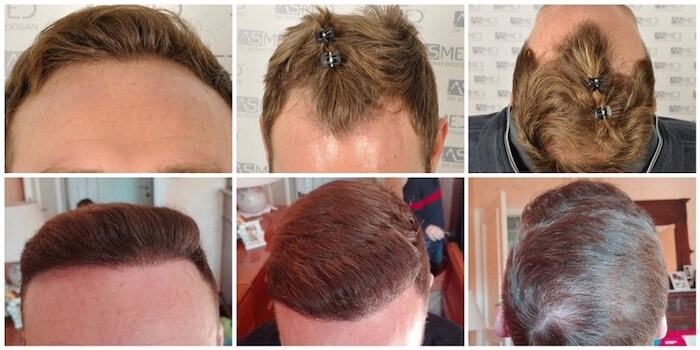 asmed hair transplant before after 1