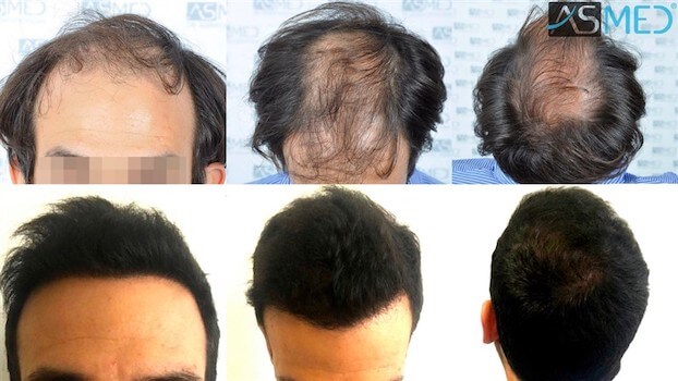 asmed hair transplant before after 2