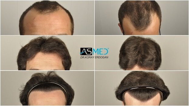 asmed hair transplant before after 3