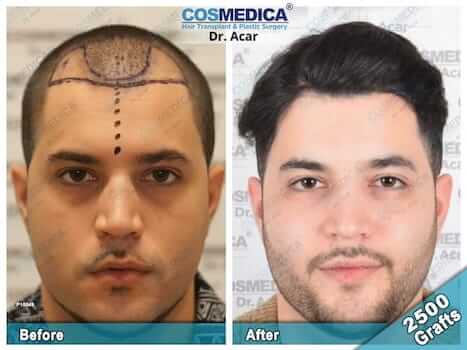 Cosmedica Hair Transplant Before After 2