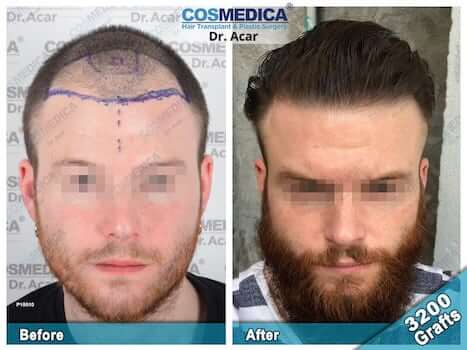 Cosmedica Hair Transplant Before After 3