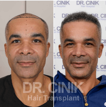 Dr. Cinik Before After 1