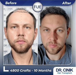 Dr. Cinik Before After 2