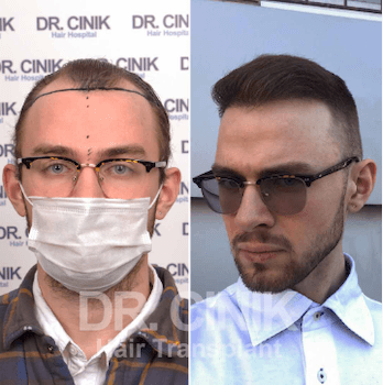 Dr. Cinik Before After 3