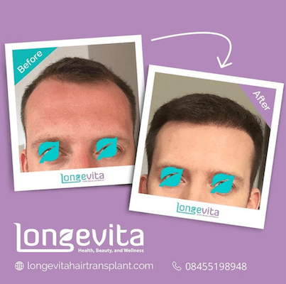 Longevita Before After 2