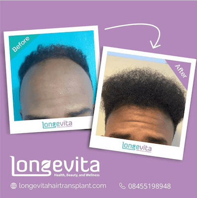 Longevita Before After 3