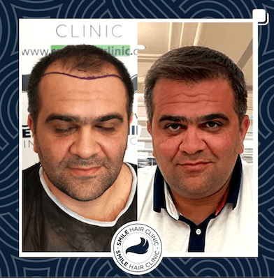 Hair Transplant Turkey Before After - Smile Hair Clinic