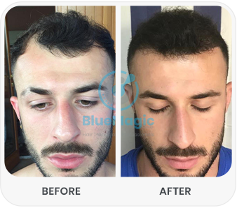 BlueMagic Group Clinic Before After 3