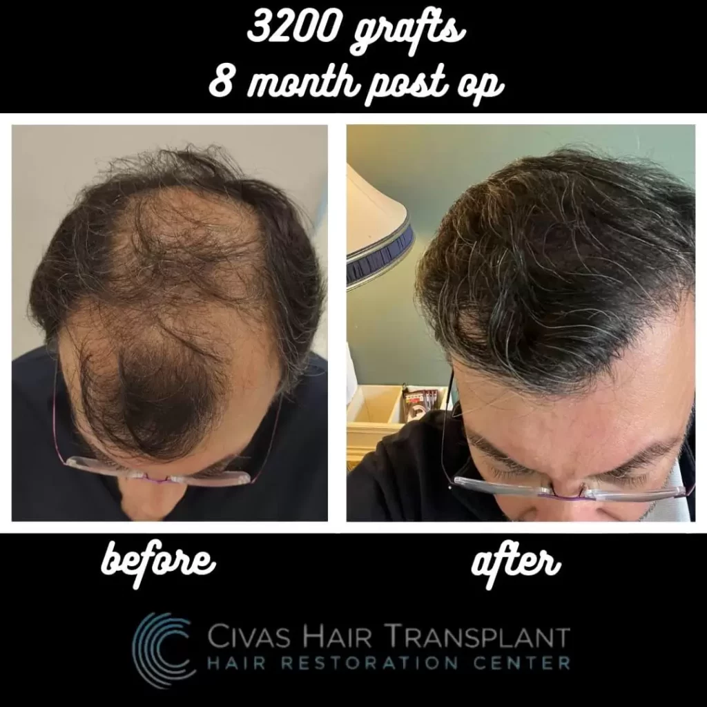 Civas Hair Transplant Patient